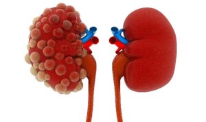 Polikistik Böbrek Hastalığı: Belirtiler, Tanı ve Tedavi