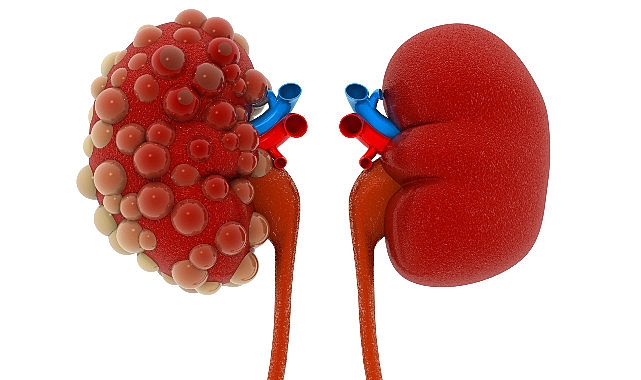 Polikistik Böbrek Hastalığı: Belirtiler, Tanı ve Tedavi