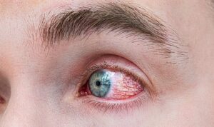 Bahar Alerjisinde Göz Ovalamak Körlüğe Yol Açıyor