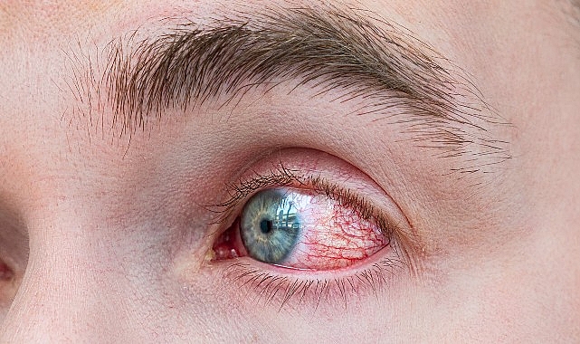Bahar Alerjisinde Göz Ovalamak Körlüğe Yol Açıyor